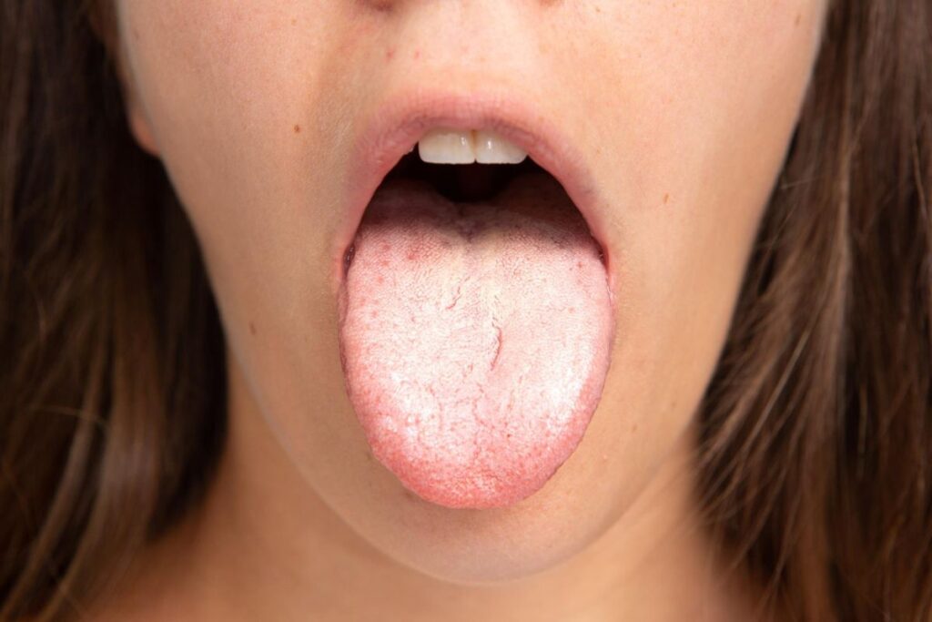 Close-up of a person sticking out their tongue, revealing a white coating, suggesting Candida in mouth or oral thrush.