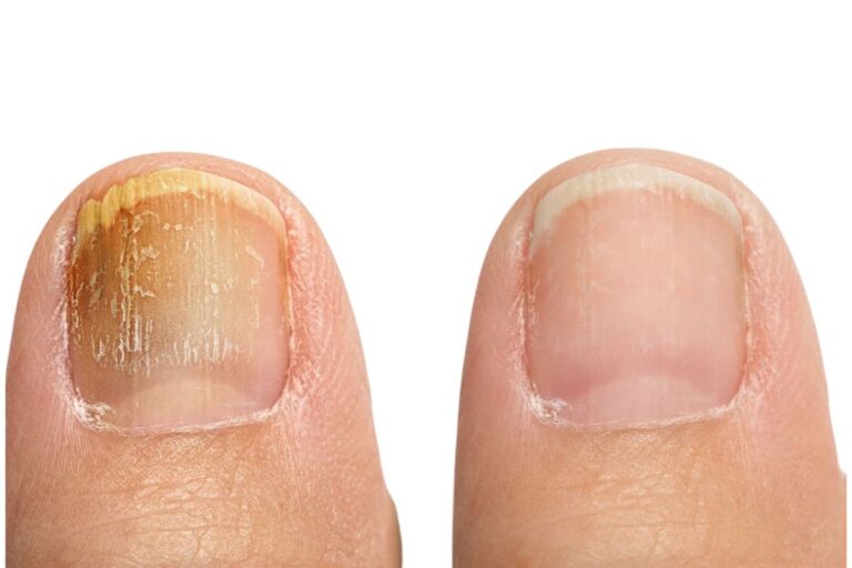 Nail Fungus: Symptoms, Causes, Best Treatment and Cure