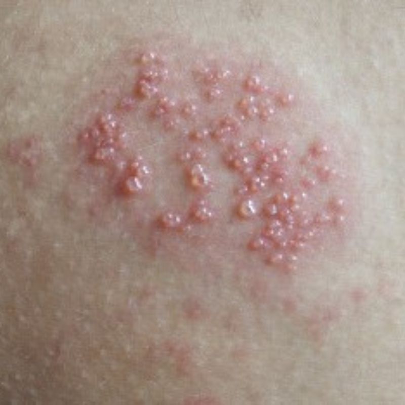 Close-up image of a skin rash with clusters of red, raised bumps on a light skin background, resembling what genital herpes looks like.