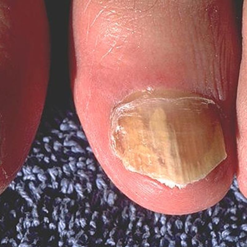 Close-up of a foot with a thick, discolored toenail, indicating a possible fungal infection. The nail appears yellowish and brittle. The background is a blue textured fabric.