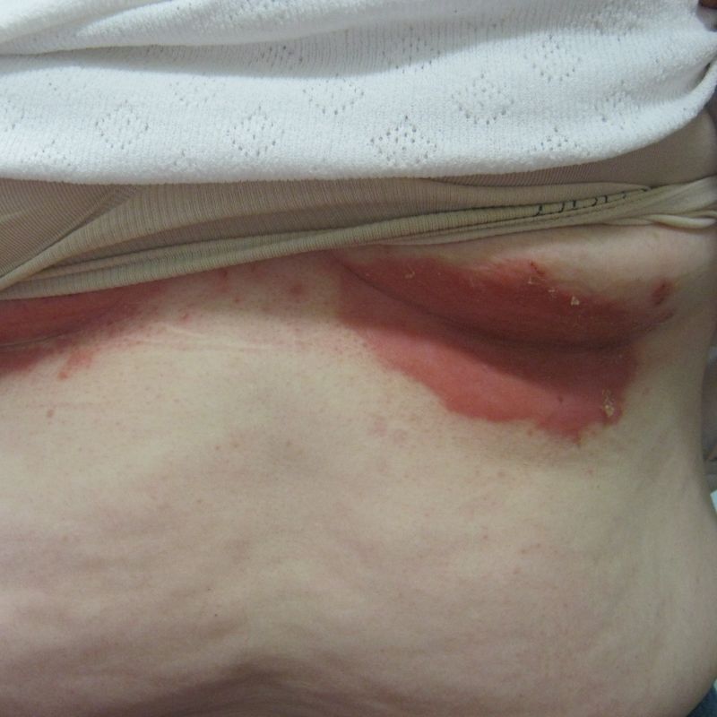 Close-up of a person's abdomen with reddish irritation under the fold of skin, likely caused by friction or infection.