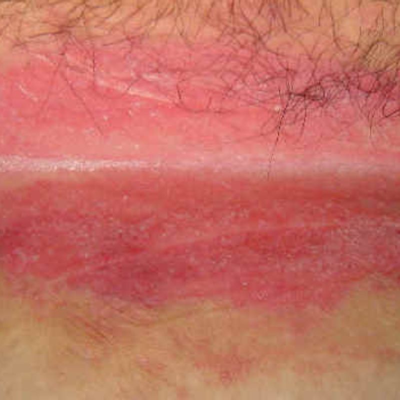 Close-up of a red, irritated skin area with some dry and peeling patches, located near a slightly hairy region.
