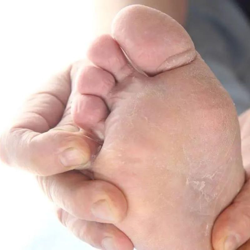 Close-up of a person's hand holding and examining the sole of their foot, which appears dry and cracked. Considering apple cider vinegar benefits, it might be worth exploring as a remedy for such skin issues.