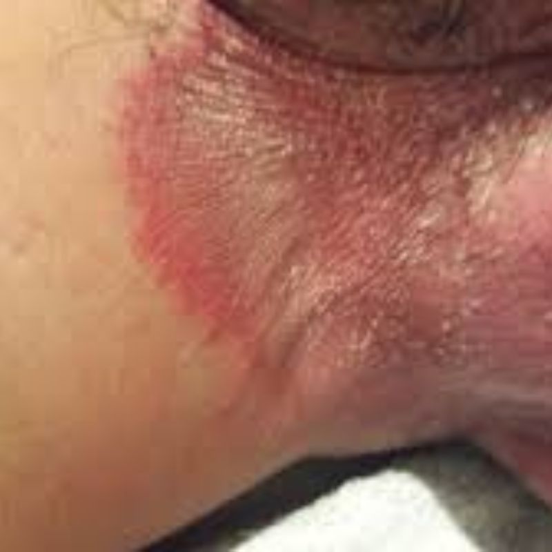 Close-up of irritated, reddish skin with dry, textured patches resembling jock itch symptoms.