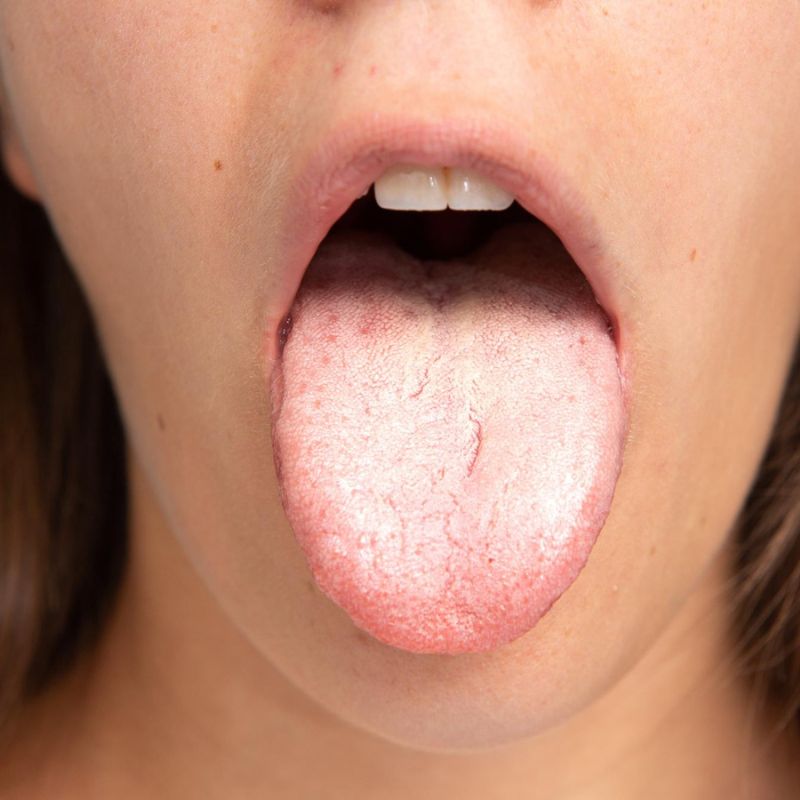 Close-up of a person's open mouth with their tongue sticking out, showing oral thrush