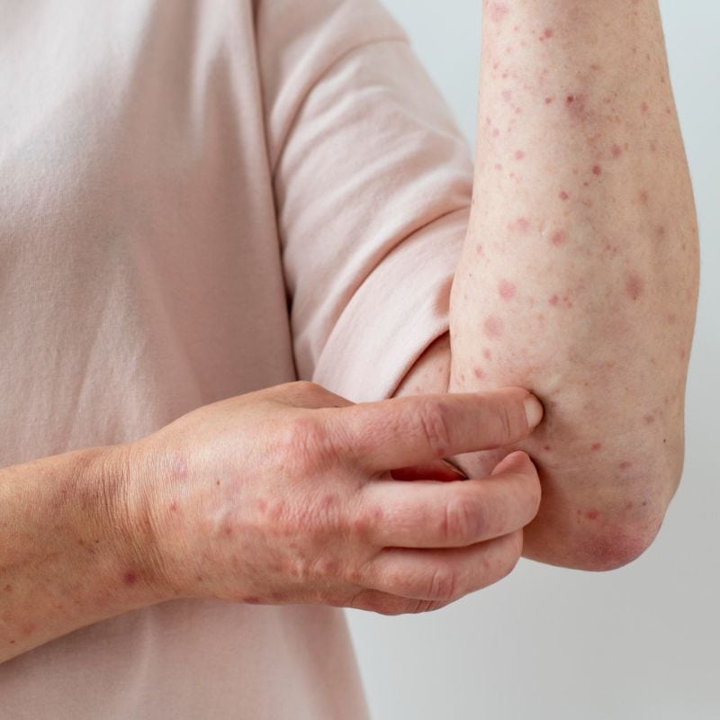 An individual examining a rash on their forearm.