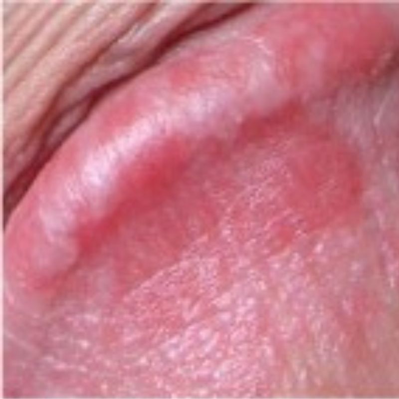 Close-up image of a red, swollen, and slightly raised area on the skin, indicating an irritation or possible allergic reaction. This presentation is similar to symptoms one might observe with penile yeast infections.