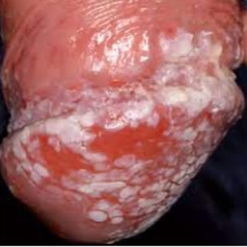 Close-up of red and inflamed skin with patches of white, scaly lesions, resembling symptoms found in penile yeast infections.