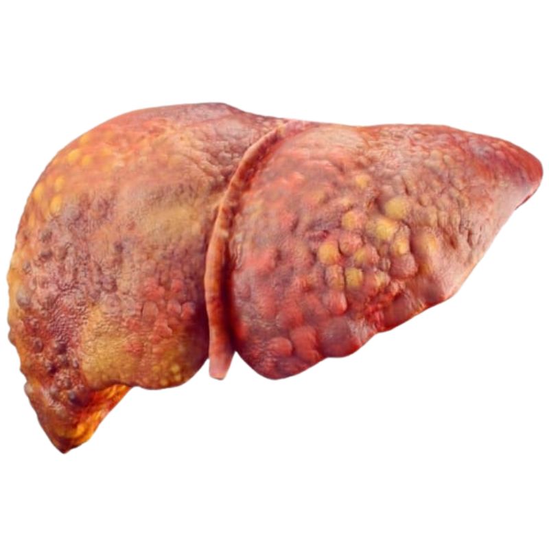 An illustration of a human liver displaying signs of cirrhosis, with a rough texture and irregular, nodular surface.